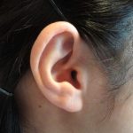 耳管開放症の症状?耳管開放症の治療?